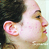 Acne Treatment After