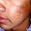 Acne Treatment After