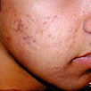 Acne Treatment After