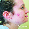 Acne Treatment before