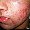 Acne Treatment Before