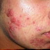 Acne Treatment Before