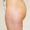 Cellulite & Unwanted Fat - After