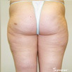 Cellulite & Unwanted Fat - After