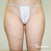 Cellulite & Unwanted Fat - After
