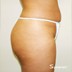 Cellulite & Unwanted Fat - After