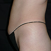 Cellulite & Unwanted Fat - After