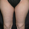 Cellulite & Unwanted Fat - After