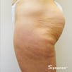 Cellulite & Unwanted Fat - Before