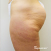 Cellulite & Unwanted Fat - Before