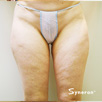 Cellulite & Unwanted Fat - Before