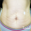 Cellulite & Unwanted Fat - Before