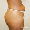 Cellulite & Unwanted Fat - Before