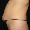 Cellulite & Unwanted Fat - Before