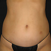 Cellulite & Unwanted Fat - Before