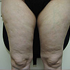 Cellulite & Unwanted Fat - Before