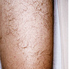 Hair Removal - After