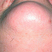 Hair Removal - After