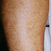 Hair Removal - After