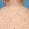 Hair Removal - After