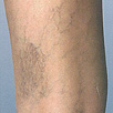 Leg Veins - Before