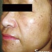 Skin Rejuvenation - After