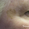 Skin Rejuvenation - Before