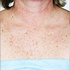 Skin Rejuvenation - Before