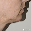 Skin Tightening Refirme - After