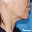 Skin Tightening Refirme - After