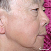 Skin Tightening Refirme - After