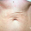 Skin Tightening Refirme - After