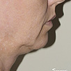 Skin Tightening Refirme - Before