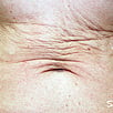 Skin Tightening Refirme - Before