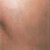 tattoo-removal-after